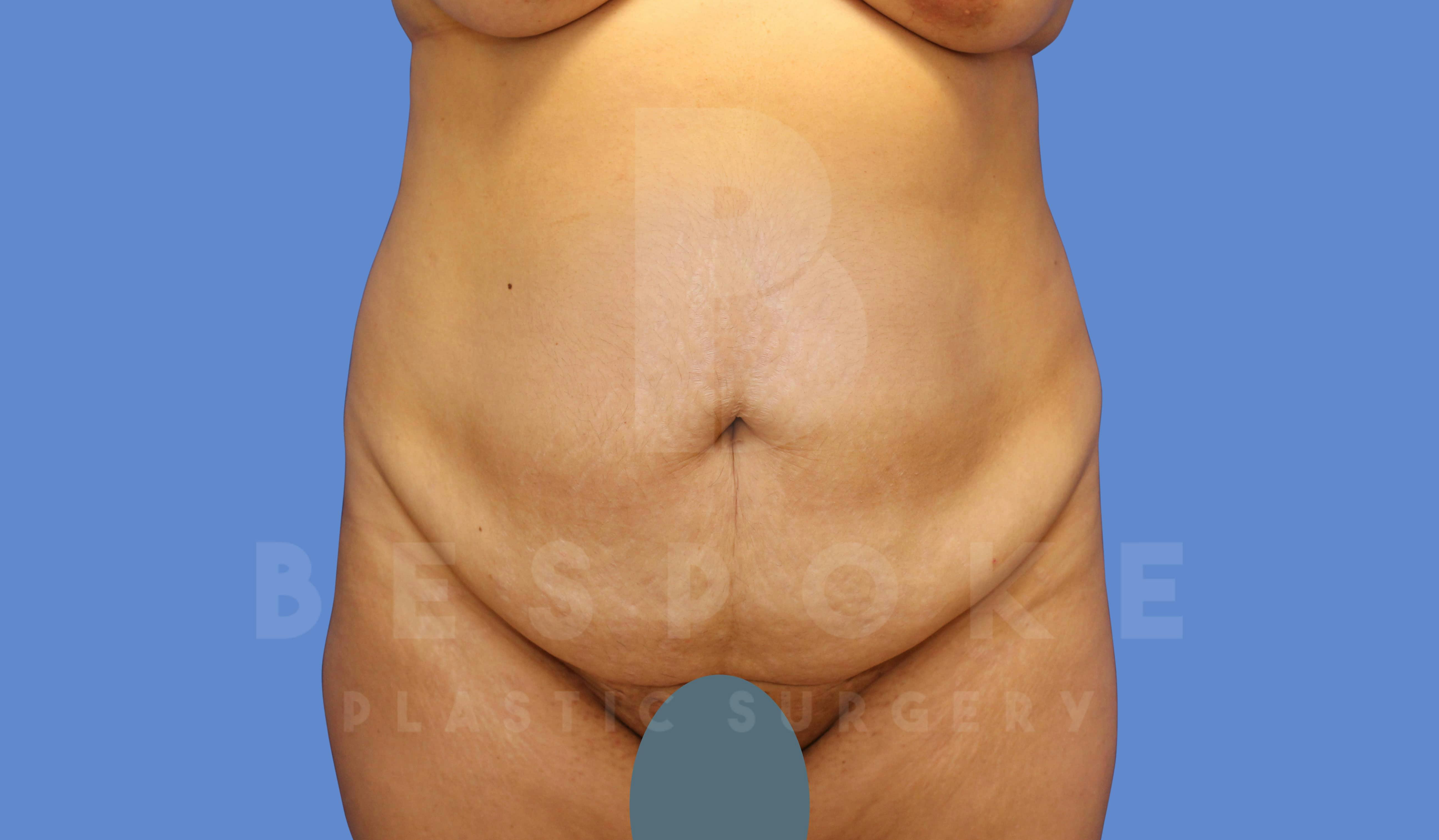 Tummy Tuck Before & After Gallery - Patient 143775180 - Image 1