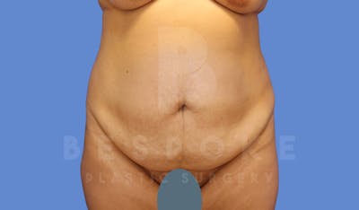 Tummy Tuck Before & After Gallery - Patient 143775180 - Image 1
