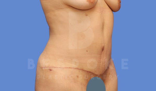 Tummy Tuck Before & After Gallery - Patient 143775180 - Image 4