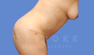 Tummy Tuck Before & After Gallery - Patient 143775180 - Image 6