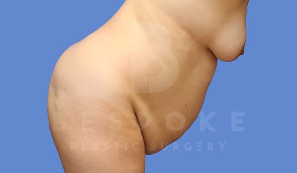 Tummy Tuck Before & After Gallery - Patient 143775180 - Image 5