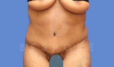 Tummy Tuck Before & After Gallery - Patient 143775182 - Image 2