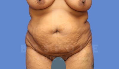 Tummy Tuck Before & After Gallery - Patient 143775182 - Image 1