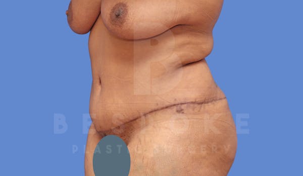 Tummy Tuck Before & After Gallery - Patient 143775182 - Image 4