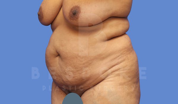 Tummy Tuck Before & After Gallery - Patient 143775182 - Image 3