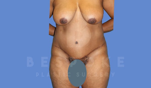 Tummy Tuck Before & After Gallery - Patient 143775181 - Image 2
