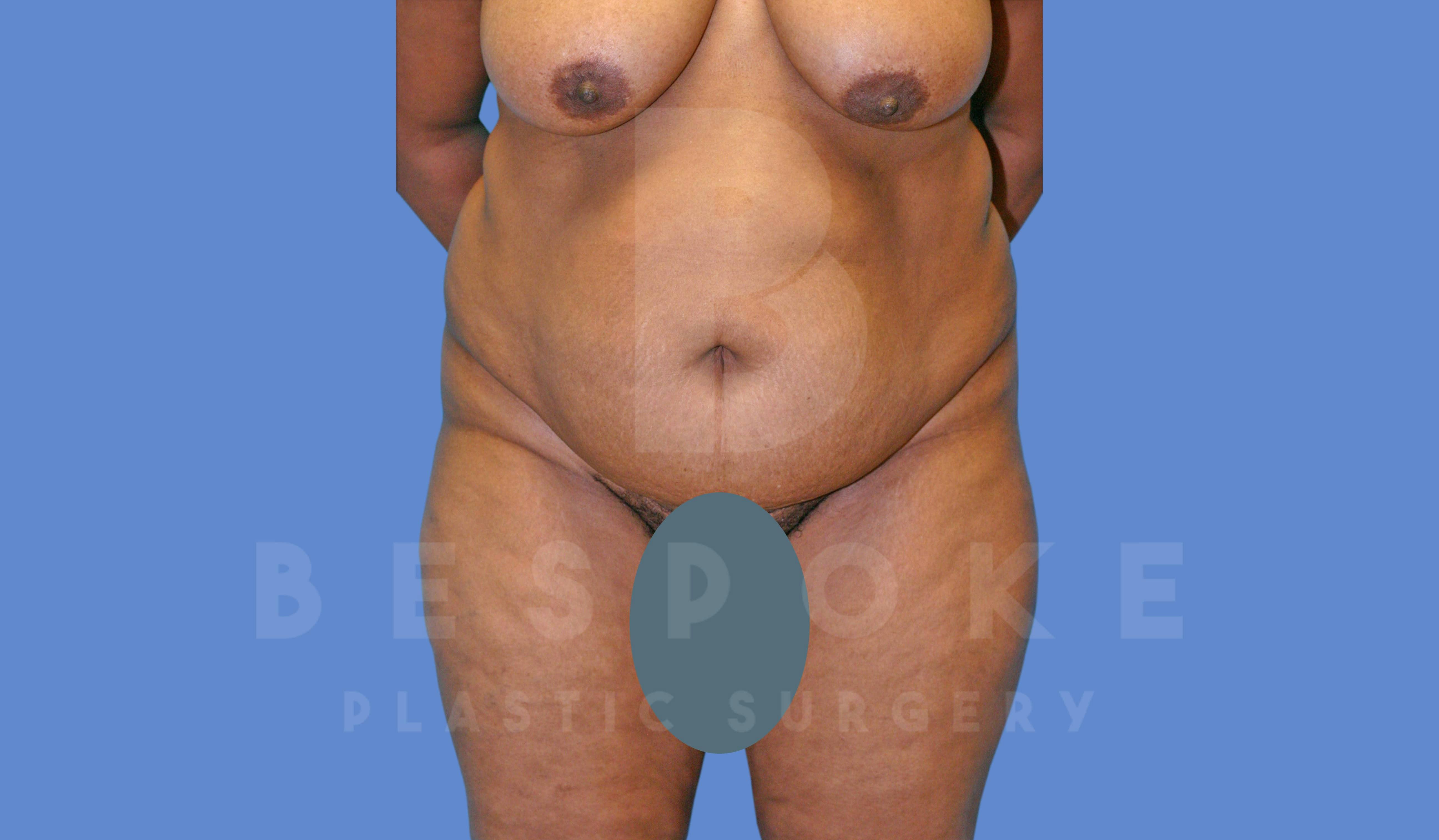 Tummy Tuck Before & After Gallery - Patient 143775181 - Image 1