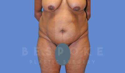 Tummy Tuck Before & After Gallery - Patient 143775181 - Image 1