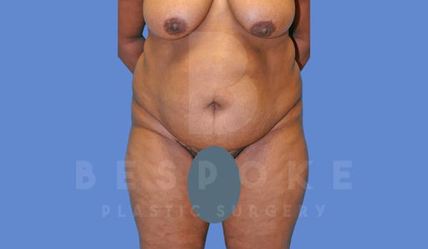 Tummy Tuck Before & After Gallery - Patient 143775181 - Image 1