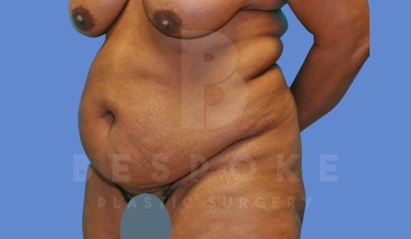 Tummy Tuck Before & After Gallery - Patient 143775181 - Image 3