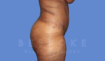 Tummy Tuck Before & After Gallery - Patient 143775181 - Image 6