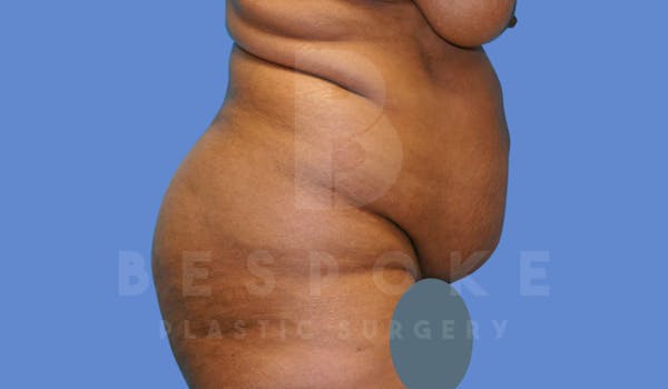 Tummy Tuck Before & After Gallery - Patient 143775181 - Image 5