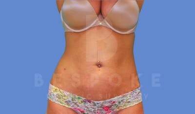 Liposuction Before & After Gallery - Patient 143775200 - Image 2