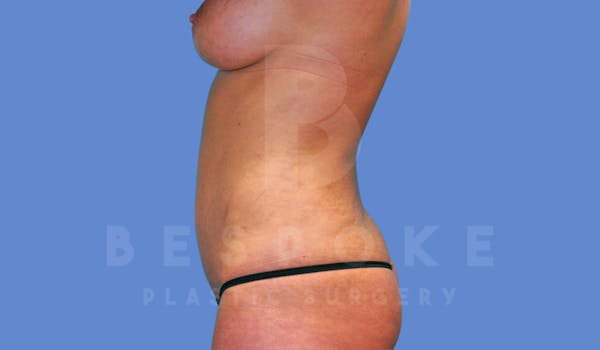 Liposuction Before & After Gallery - Patient 143775200 - Image 6
