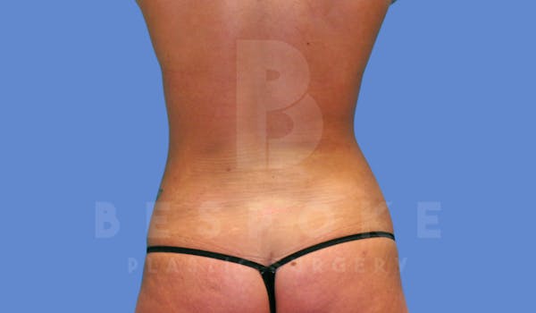 Liposuction Before & After Gallery - Patient 143775200 - Image 8