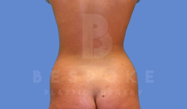 Liposuction Before & After Gallery - Patient 143775200 - Image 7