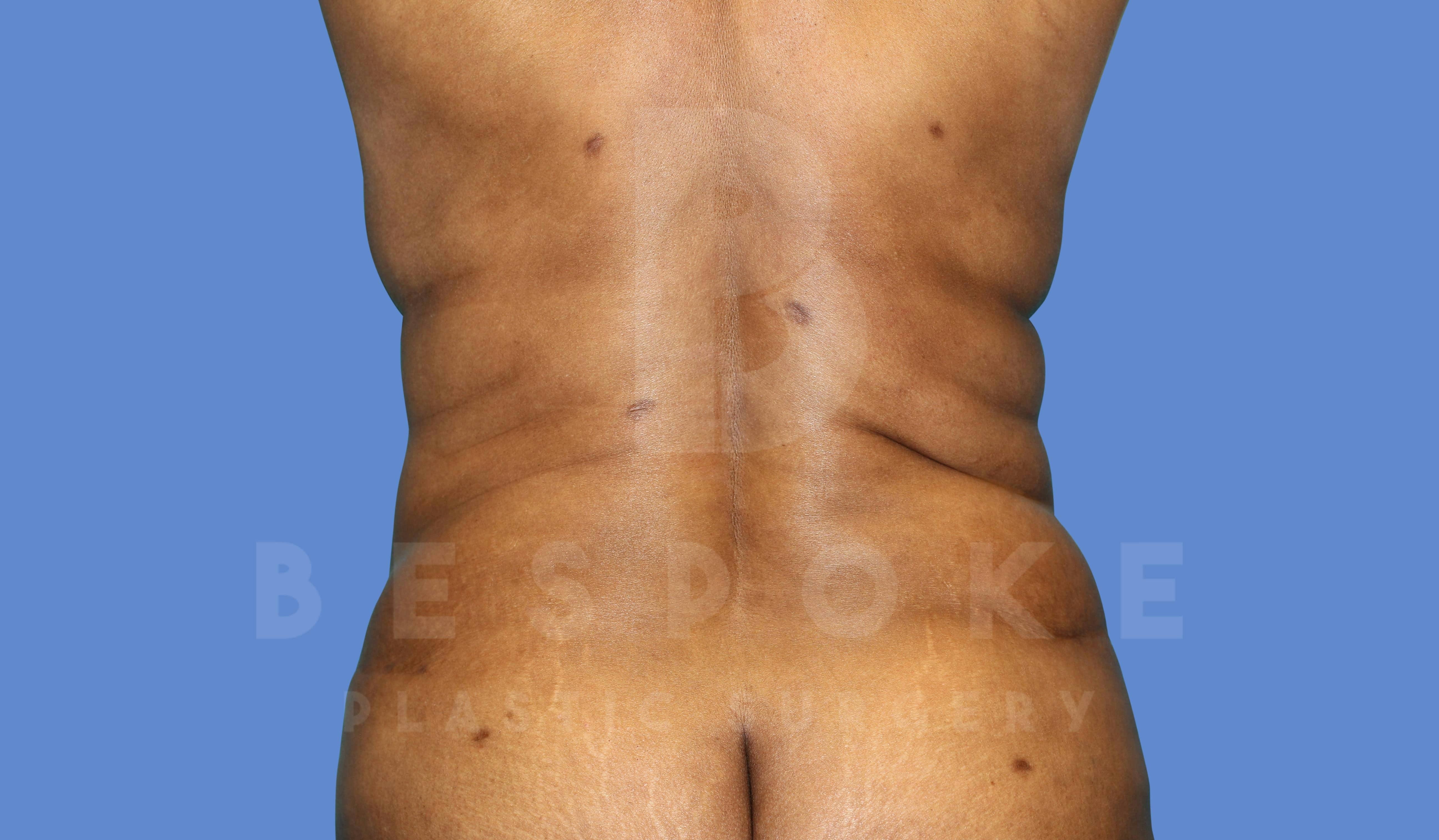 Liposuction Before & After Gallery - Patient 143775201 - Image 2