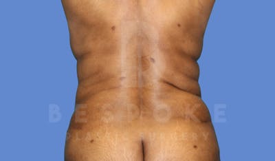 Liposuction Before & After Gallery - Patient 143775201 - Image 2