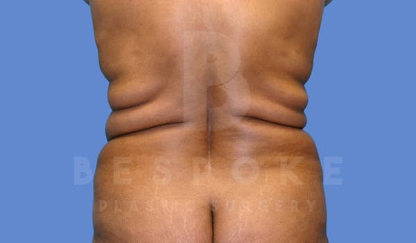 Liposuction Before & After Gallery - Patient 143775201 - Image 1