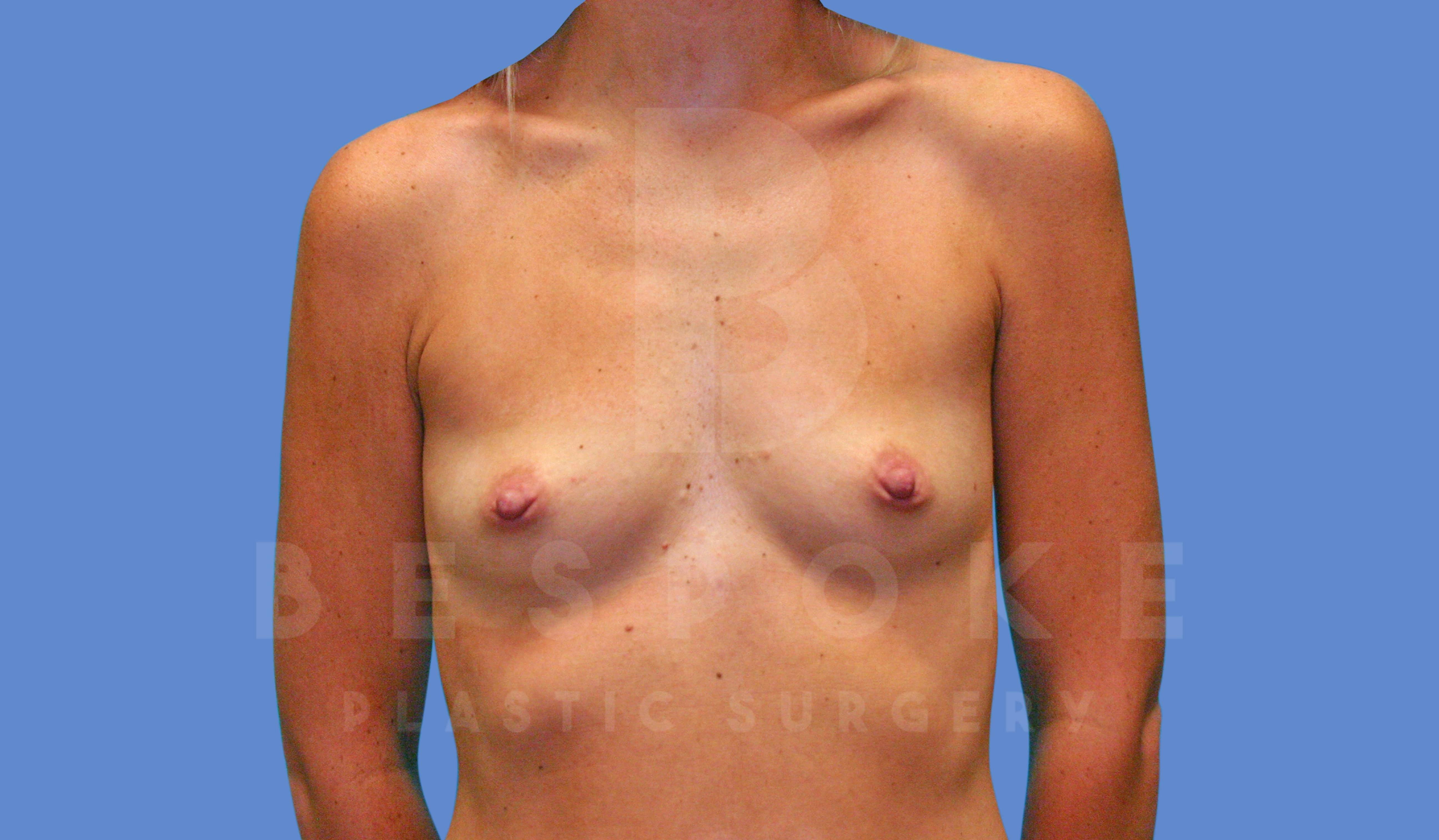Breast Augmentation Before & After Gallery - Patient 143775215 - Image 1