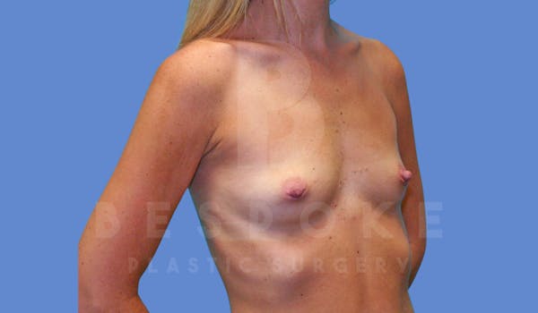 Breast Augmentation Before & After Gallery - Patient 143775215 - Image 3