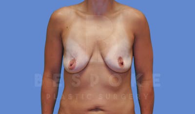 Breast Augmentation Before & After Gallery - Patient 143775216 - Image 1