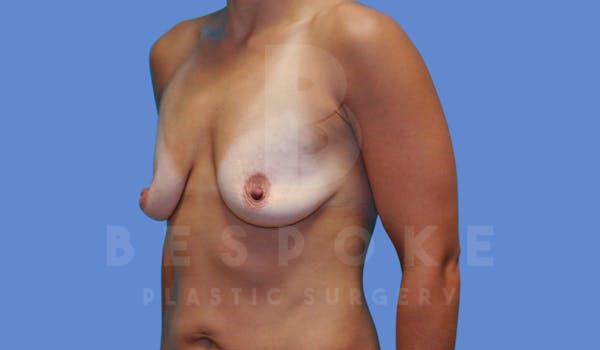 Breast Augmentation Before & After Gallery - Patient 143775216 - Image 3