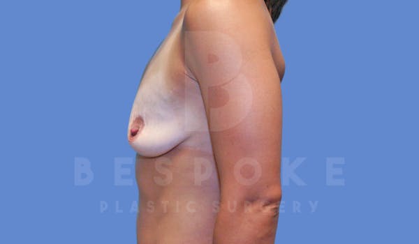 Breast Augmentation Before & After Gallery - Patient 143775216 - Image 5