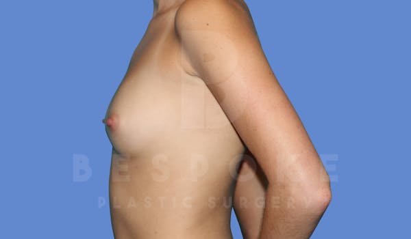 Breast Augmentation Before & After Gallery - Patient 143775217 - Image 5