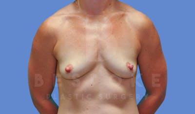 Breast Augmentation Before & After Gallery - Patient 143775218 - Image 1