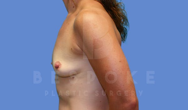 Breast Augmentation Before & After Gallery - Patient 143775218 - Image 3