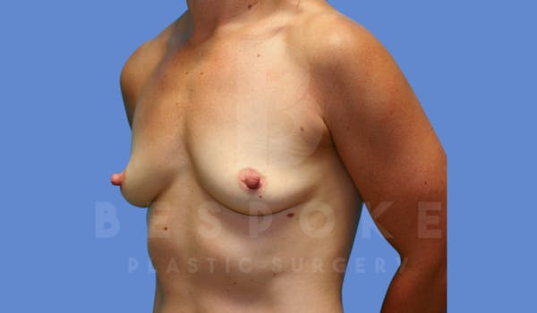 Breast Augmentation Before & After Gallery - Patient 143775218 - Image 5