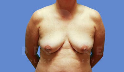 Breast Lift With Implants Before & After Gallery - Patient 143775248 - Image 1