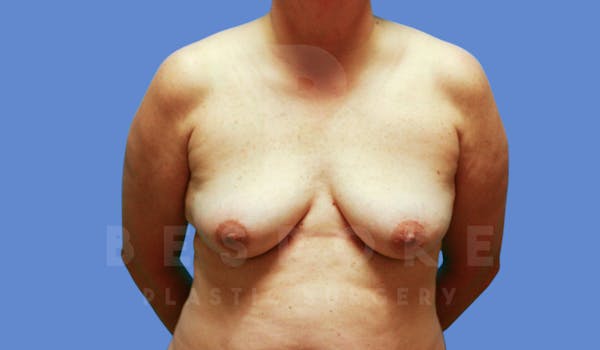 Breast Lift With Implants Before & After Gallery - Patient 143775248 - Image 1