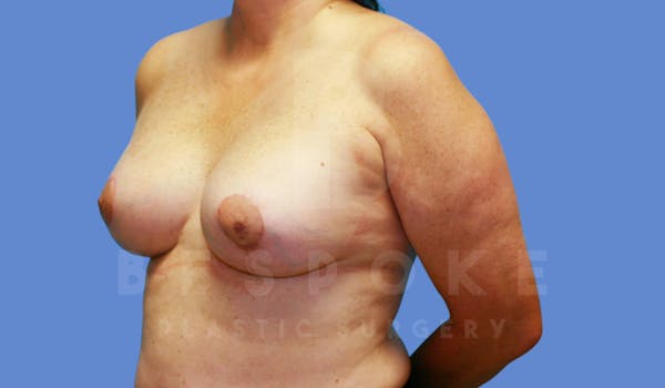 Breast Lift With Implants Before & After Gallery - Patient 143775248 - Image 4