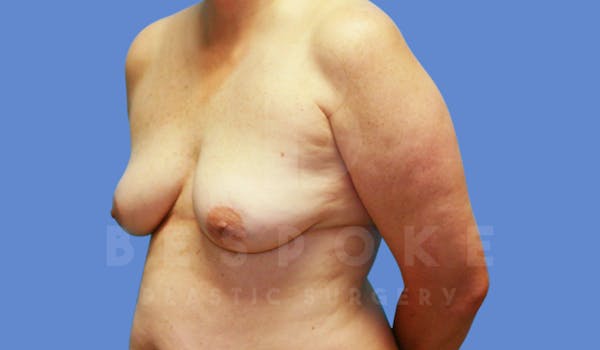Breast Lift With Implants Before & After Gallery - Patient 143775248 - Image 3