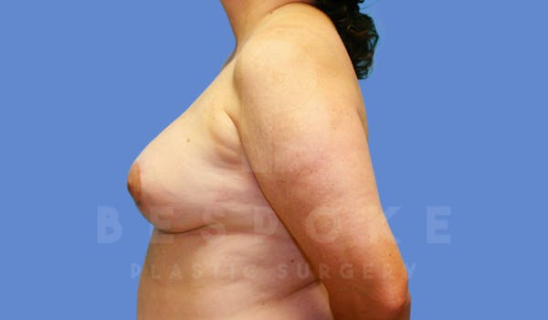 Breast Lift With Implants Before & After Gallery - Patient 143775248 - Image 6