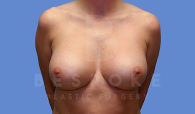 Breast Revision Surgery Before & After Gallery - Patient 143775289 - Image 2