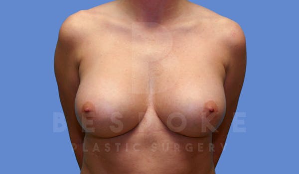 Breast Revision Surgery Before & After Gallery - Patient 143775289 - Image 2