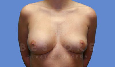 Breast Revision Surgery Before & After Gallery - Patient 143775289 - Image 1