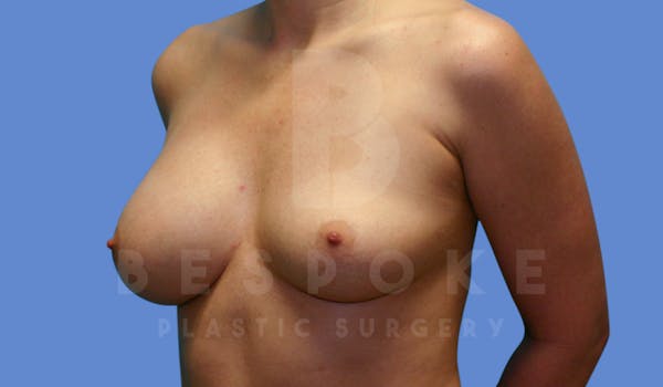 Breast Revision Surgery Before & After Gallery - Patient 143775289 - Image 3