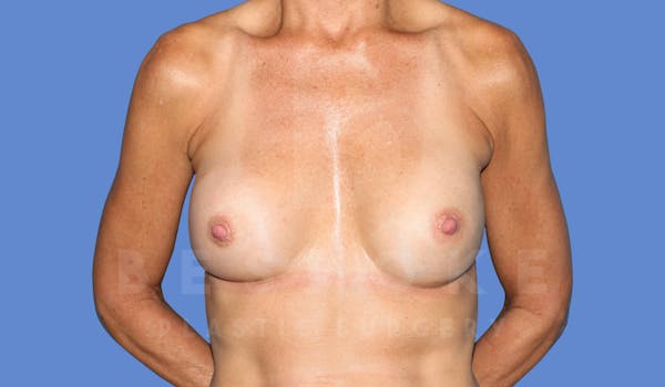 Breast Revision Surgery Before & After Gallery - Patient 143775290 - Image 2