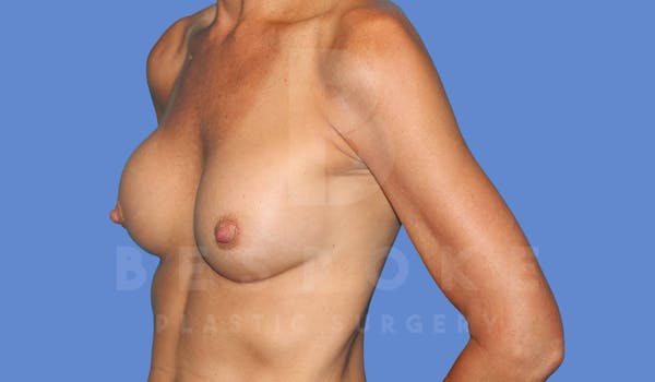 Breast Revision Surgery Before & After Gallery - Patient 143775290 - Image 3