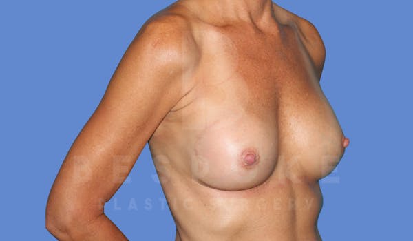 Breast Revision Surgery Before & After Gallery - Patient 143775290 - Image 6
