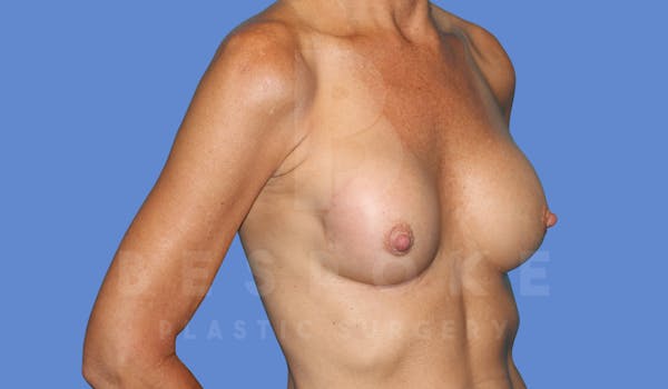 Breast Revision Surgery Before & After Gallery - Patient 143775290 - Image 5