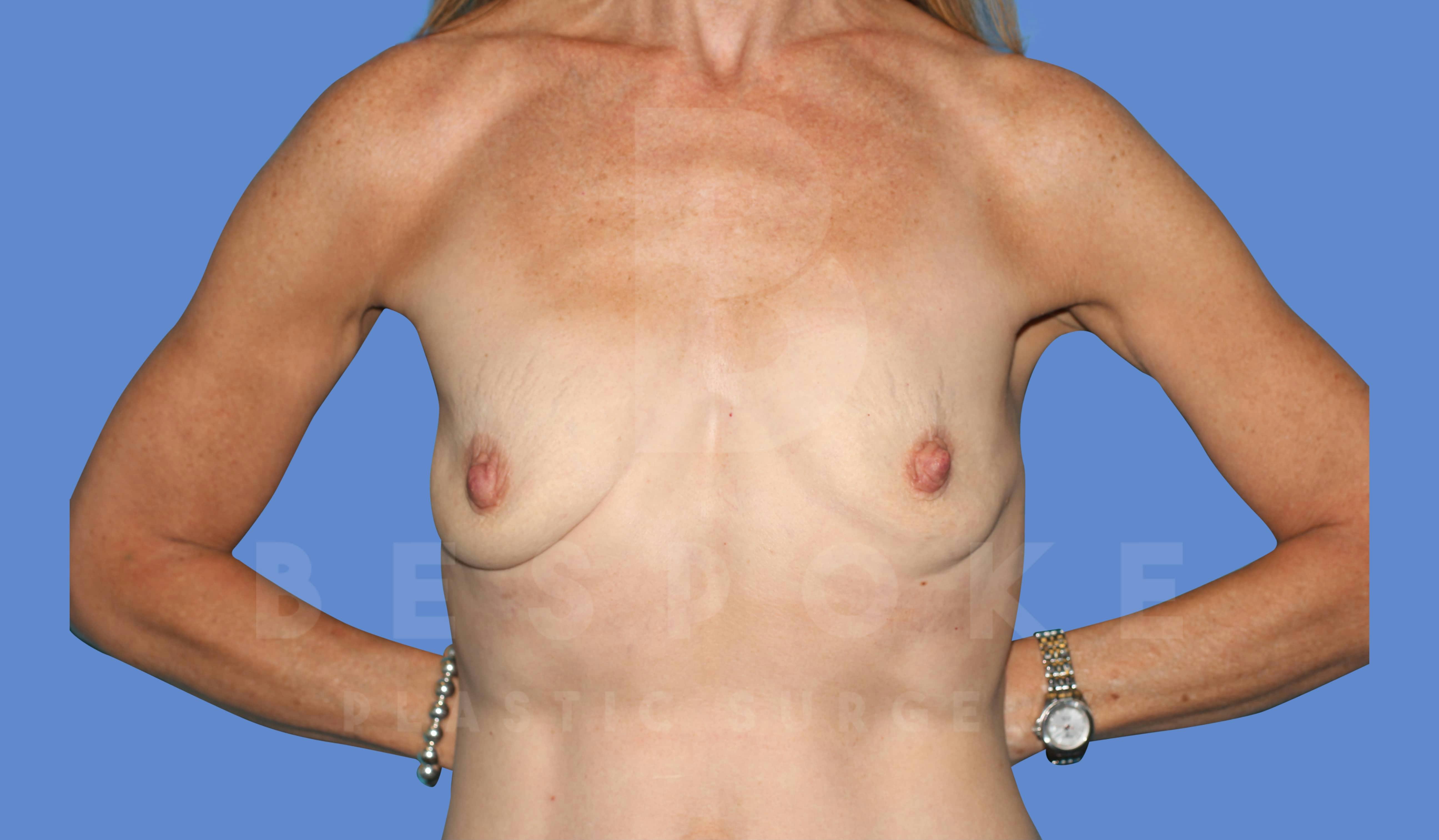 Breast Augmentation Before & After Gallery - Patient 143802335 - Image 1