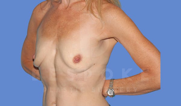 Breast Augmentation Before & After Gallery - Patient 143802335 - Image 3