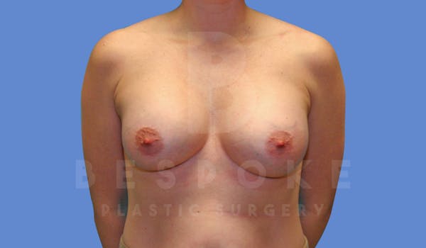 Breast Augmentation Before & After Gallery - Patient 143802336 - Image 2
