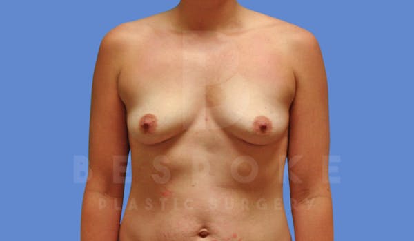 Breast Augmentation Before & After Gallery - Patient 143802336 - Image 1