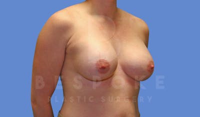 Breast Augmentation Before & After Gallery - Patient 143802336 - Image 6